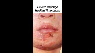 Severe Skin Infection Healing Time Lapse (0 - 30 days) #shorts @fauquierent