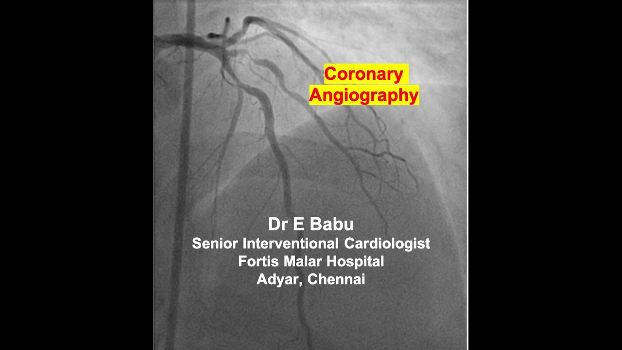 What is Coronary Angiography or Angiogram ?...Dr E Babu Cardiologist, Fortis Malar Hospital, Chennai