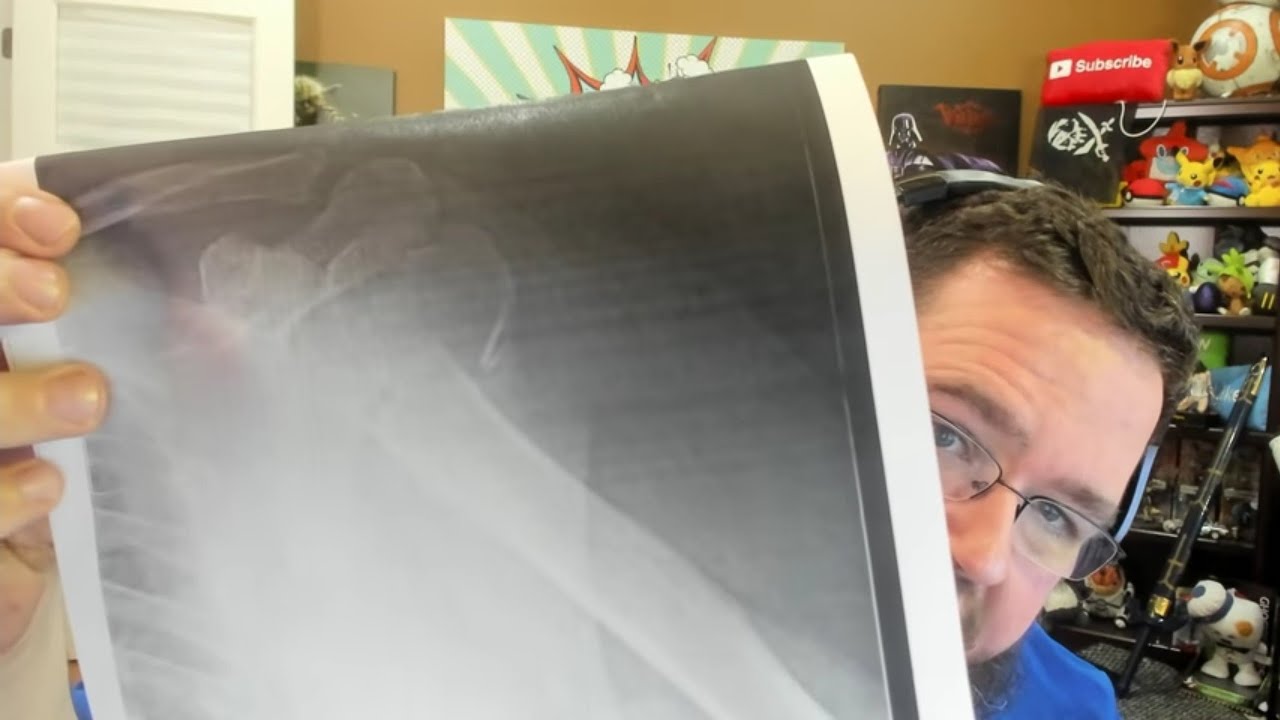 bone fracture (disease or medical condition) update on my broken arm...