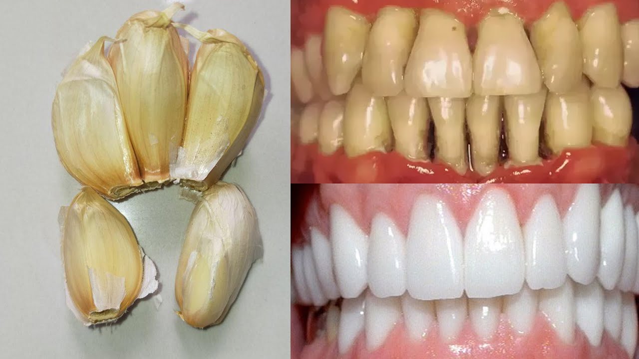 In just two minutes, How to teeth whitening with garlic at home Teeth whitening remedy YouTube