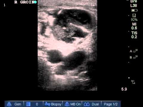 right groin abscess - YouTube