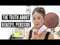 Clear Acne With Benzoyl Peroxide? (Pros and Cons)