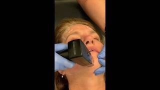 Facial Rejuvenation with Morpheus8 | Dr. David P. Rapaport NYC