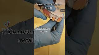 Prótesis dental removible de acrílico