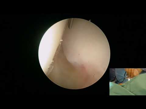 Single-Portal Arthroscopy of the Central Compartment of the Hip