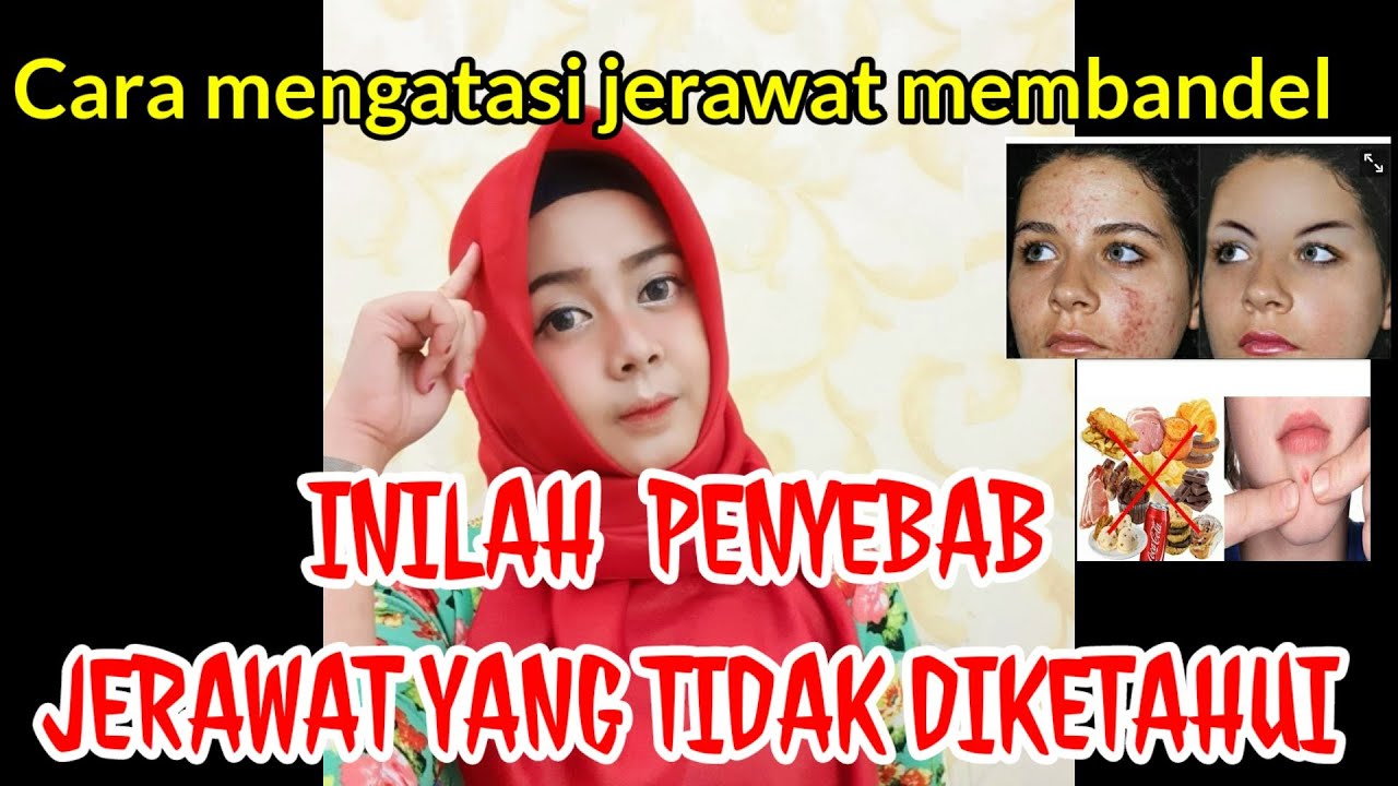 Penyebab Terjadinya Jerawat yang tidak diketahui ? 