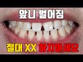 앞니 벌어짐 절대 XX 하지마세요 (앞니 벌어짐 치료 완벽 정리!)