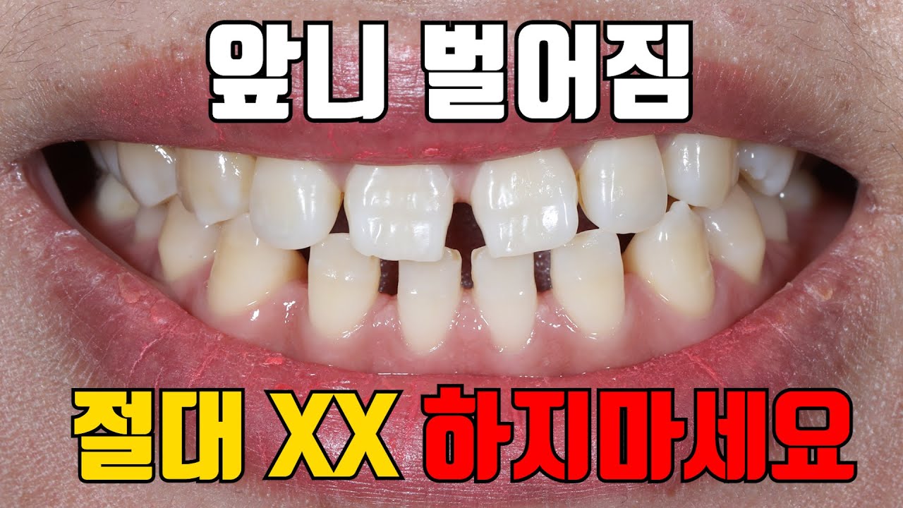 앞니 벌어짐 절대 XX 하지마세요 (앞니 벌어짐 치료 완벽 정리!)