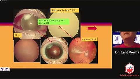 Webinar 2. AIOS ARC RETINA UPDATE SERIES - 1