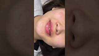 #adana #dolgu #öncesisonrası #keşfetbeniöneçıkar