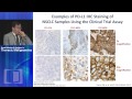 Immunotherapy in NSCLC - Promises and Challenges
