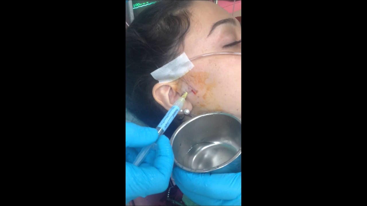 TMJ Arthrocentesis With Lysis And Lavage YouTube