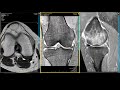 Knee MRI - Meniscocapsular Separation and Subchondral Insufficiency Fracture (SIF)