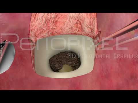 Vídeo: Què és la cirurgia dental apico?