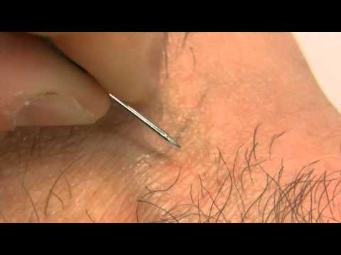 How to remove an ingrown hair