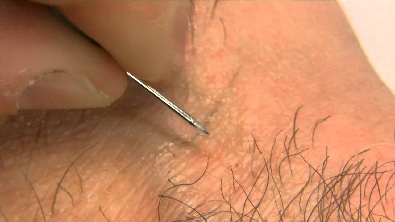 How To Remove An Ingrown Hair Youtube
