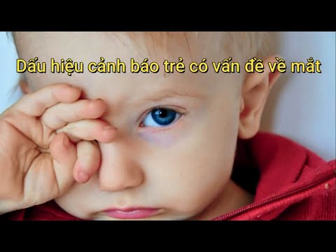 Video: Phải Làm Gì Nếu Một Em Bé Có Mắt ác