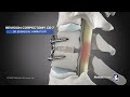 3d surgery animation portrays cervical spine revisions