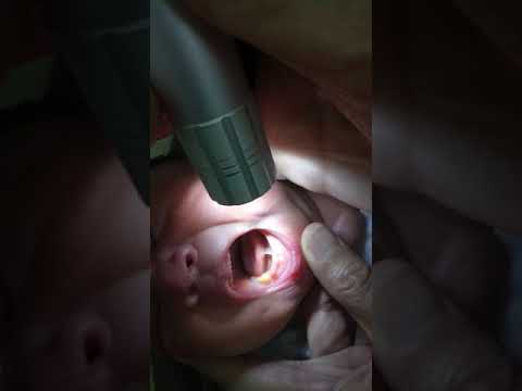 วีดีโอ: สุขภาพสำหรับทารก A-Z: Tongue-Tie