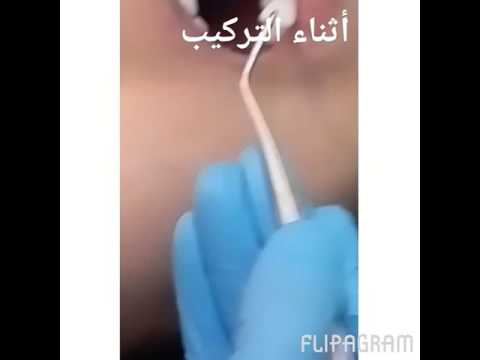 عيادات القاضي لطب الأسنان جده شارع حراء تقاطع طريق المدينة جوال رقم 0542704924
