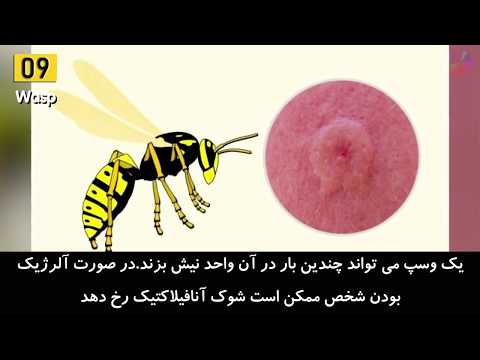 علائم و عوارض نیش ساس