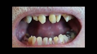 Full Mouth Rehab  Part 1  Dr. Mark Durham