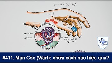 #411. Mụn cóc từ đâu ra?