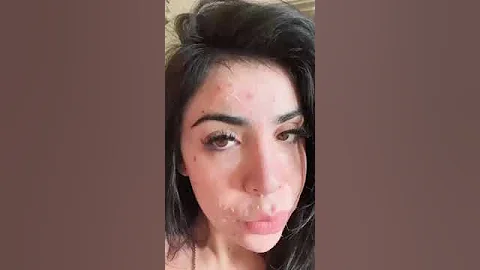 Chemical peels season.