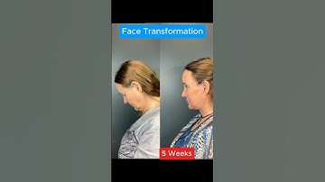 Amazing 5 Week Facelift Transformation #facelift