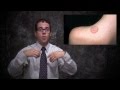 Ringworm