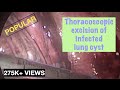 Thoracoscopic (VATS) excision of an infected lung cyst - Dr Deepraj Bhandarkar