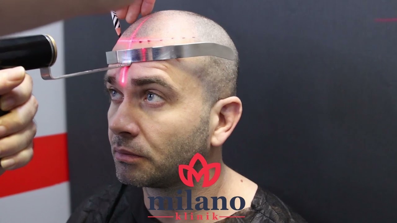 Hair Transplant (Choi - DHI - Sapphire - Stem Cell) in Turkey Istanbul