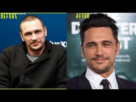 one-of-the-best-hair-transplant-results-ever!-(james-franco)