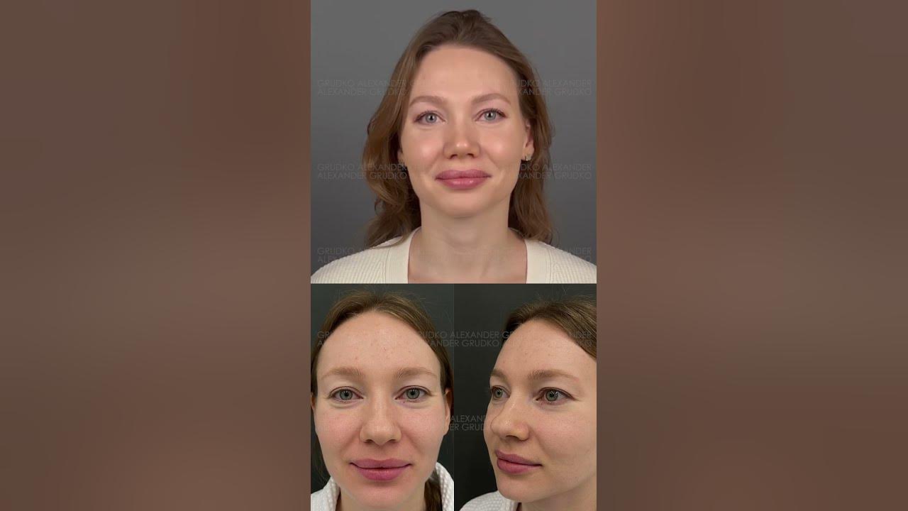 Александра урсуляк пластика носа до и после