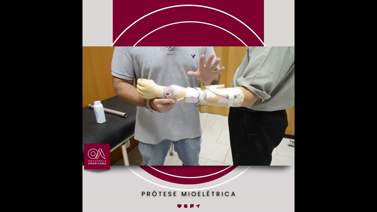 Sistema Miolétrico Simples para Amputação de Antebraço.