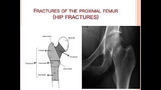 Fracture of Proximal Femur
