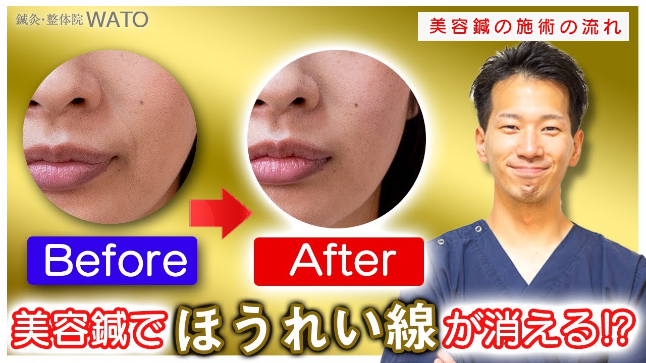 施術の流れ 美容鍼でほうれい線を消す 問診 施術 セルフケア 二子玉川 鍼灸整体院wato Youtube