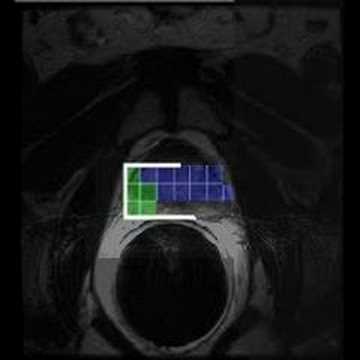 Active Shape Model Initialization