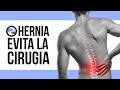 Hernia discal, 3 ejercicios para evitar la cirugia