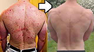 How I Healed Acne With Diet | Before & After Transformation