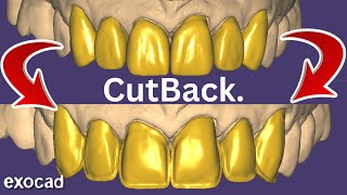 CutBack EXOCAD Big Cases. For Layering