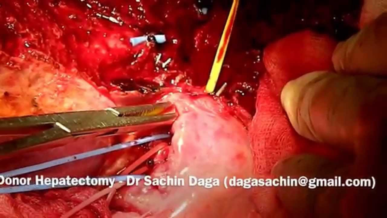 Donor hepatectomy