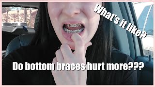 What It Like Getting Braces On The Bottom Does It Hurt More Spoiler It Does