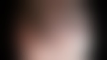 ESD of Gastrointestinal stromal tumors (GIST) and Closure of Defect using the Loop and Clip Method.