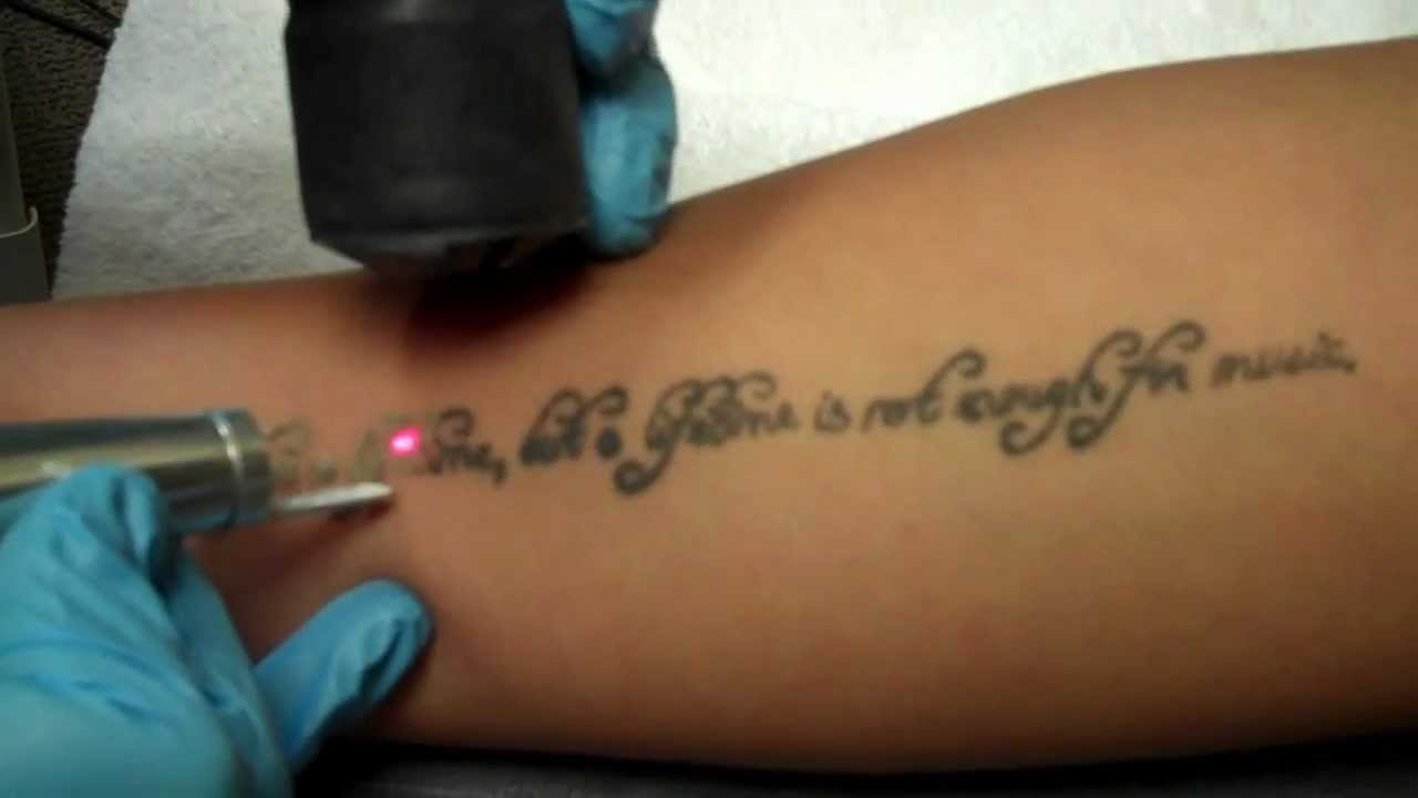 Laser Tattoo Removal - Black Ink - YouTube