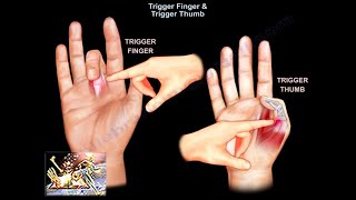 Trigger Finger \& Trigger Thumb - Everything You Need To Know - Dr. Nabil Ebraheim