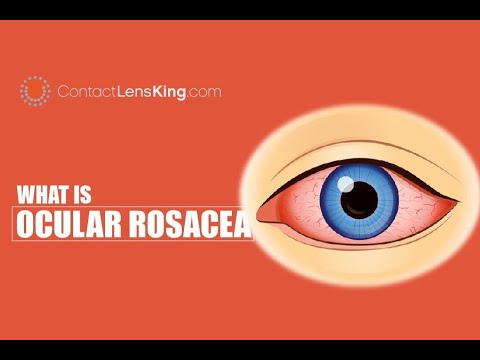 Video: Rosacea Eye - How Is It Treated? Causes, Symptoms And Treatment
