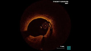 Celebrity stent edge dissection Profile