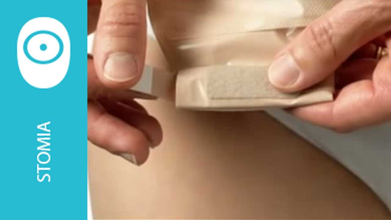 Come svuotare la sacca per ileostomia