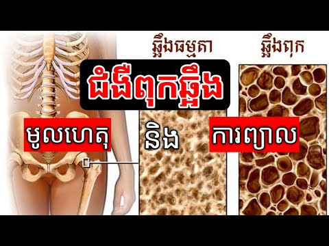 [ ជំងឺពុកឆ្អឹង ] នាទីសុខភាព | success knowledge